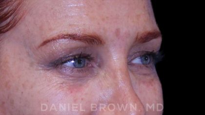 Blepharoplasty Before & After Patient #8688