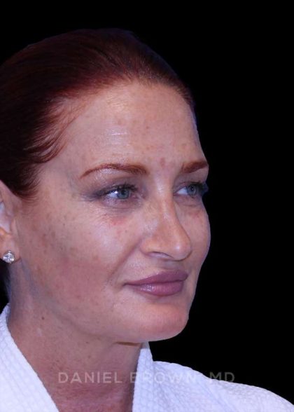 Blepharoplasty Before & After Patient #8688