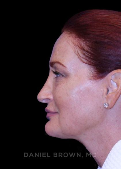 Blepharoplasty Before & After Patient #8688