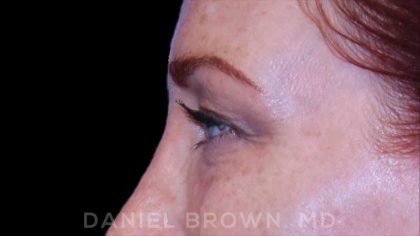 Blepharoplasty Before & After Patient #8688