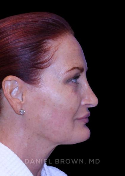Blepharoplasty Before & After Patient #8688