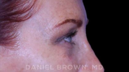 Blepharoplasty Before & After Patient #8688