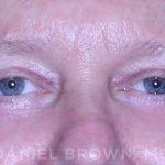 Blepharoplasty Before & After Patient #8709