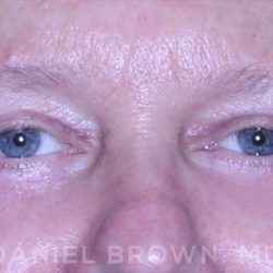 Blepharoplasty Before & After Patient #8709