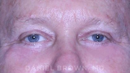 Blepharoplasty Before & After Patient #8709