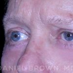 Blepharoplasty Before & After Patient #8709