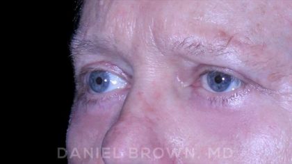 Blepharoplasty Before & After Patient #8709
