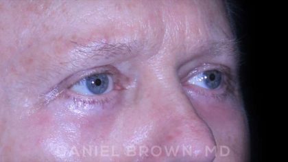 Blepharoplasty Before & After Patient #8709