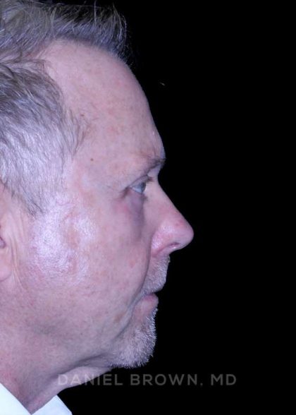Blepharoplasty Before & After Patient #8709