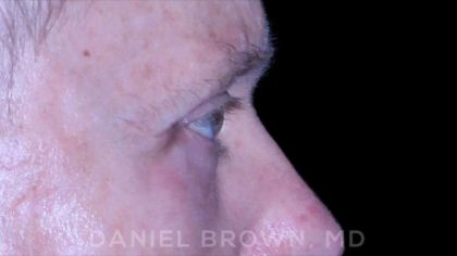 Blepharoplasty Before & After Patient #8709