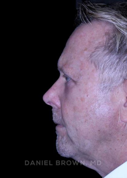 Blepharoplasty Before & After Patient #8709