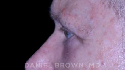 Blepharoplasty Before & After Patient #8709