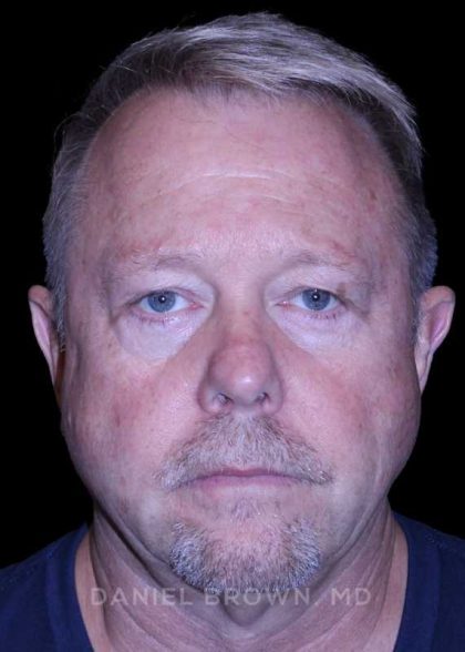Blepharoplasty Before & After Patient #8709