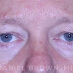 Blepharoplasty Before & After Patient #8709