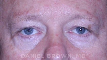 Blepharoplasty Before & After Patient #8709