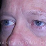 Blepharoplasty Before & After Patient #8709