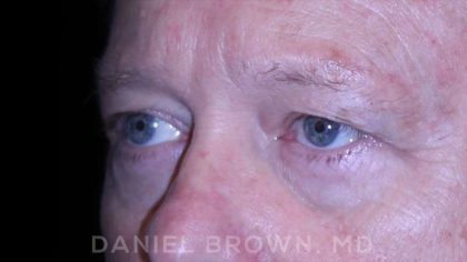 Blepharoplasty Before & After Patient #8709