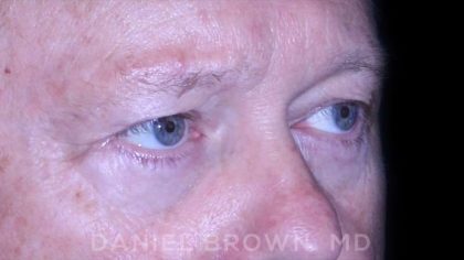 Blepharoplasty Before & After Patient #8709