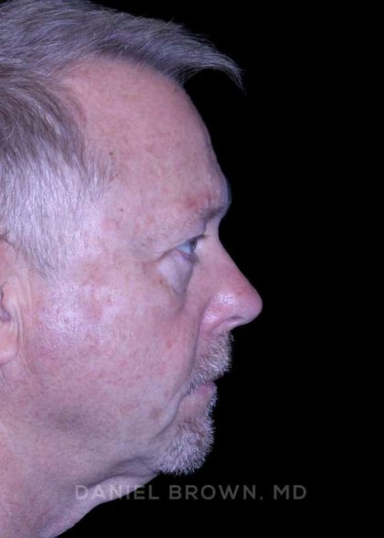 Blepharoplasty Before & After Patient #8709