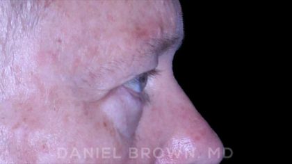 Blepharoplasty Before & After Patient #8709