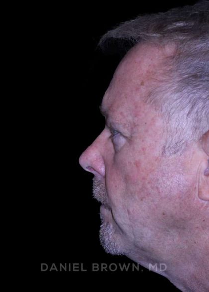 Blepharoplasty Before & After Patient #8709