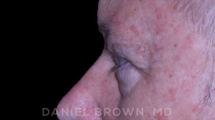Blepharoplasty Before & After Patient #8709