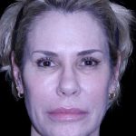 Blepharoplasty Before & After Patient #8730