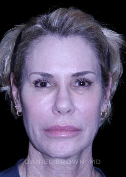 Blepharoplasty Before & After Patient #8730