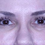 Blepharoplasty Before & After Patient #8730