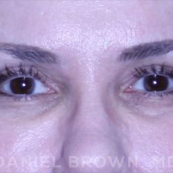 Blepharoplasty Before & After Patient #8730