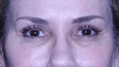 Blepharoplasty Before & After Patient #8730