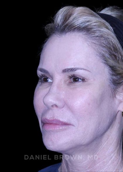 Blepharoplasty Before & After Patient #8730