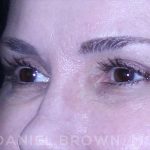 Blepharoplasty Before & After Patient #8730
