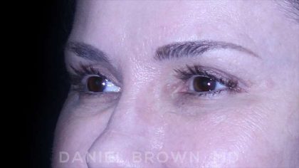 Blepharoplasty Before & After Patient #8730