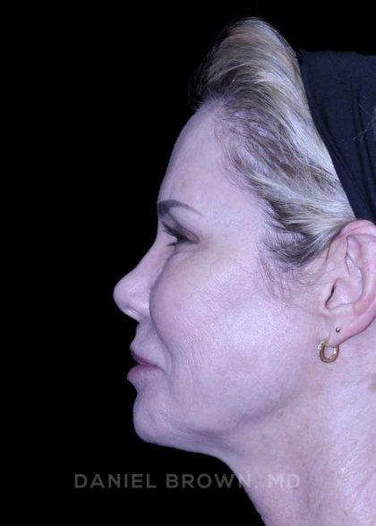 Blepharoplasty Before & After Patient #8730