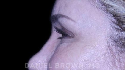 Blepharoplasty Before & After Patient #8730