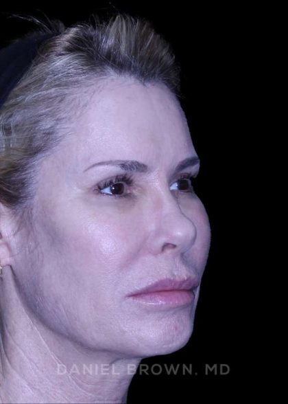 Blepharoplasty Before & After Patient #8730