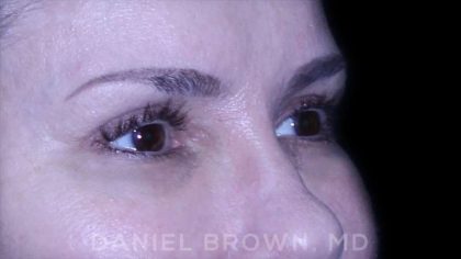 Blepharoplasty Before & After Patient #8730
