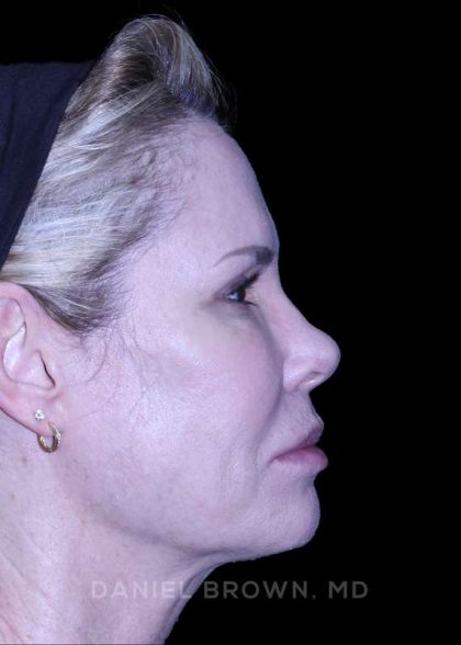 Blepharoplasty Before & After Patient #8730