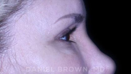 Blepharoplasty Before & After Patient #8730
