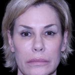 Blepharoplasty Before & After Patient #8730