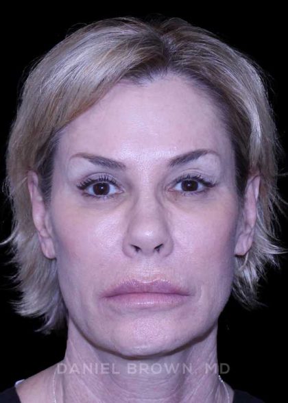 Blepharoplasty Before & After Patient #8730