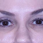 Blepharoplasty Before & After Patient #8730