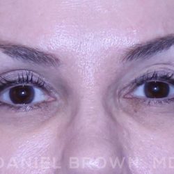 Blepharoplasty Before & After Patient #8730