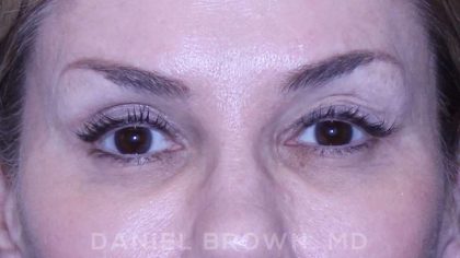 Blepharoplasty Before & After Patient #8730