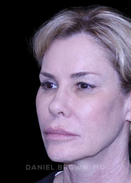 Blepharoplasty Before & After Patient #8730