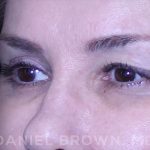 Blepharoplasty Before & After Patient #8730