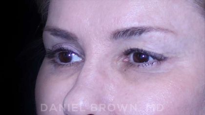 Blepharoplasty Before & After Patient #8730