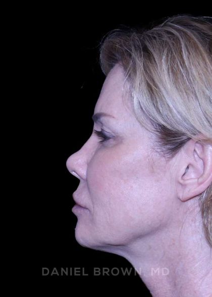 Blepharoplasty Before & After Patient #8730