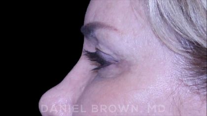 Blepharoplasty Before & After Patient #8730